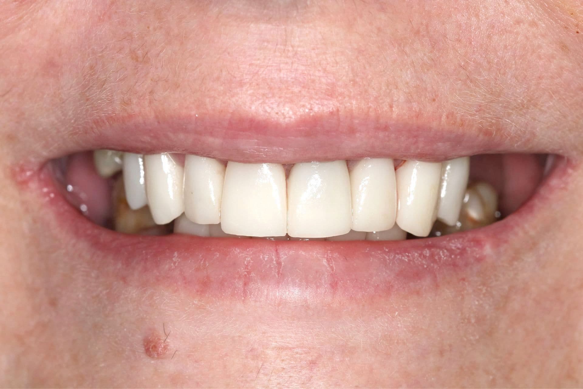 Full smile restoration with porcelain crowns, after treatment