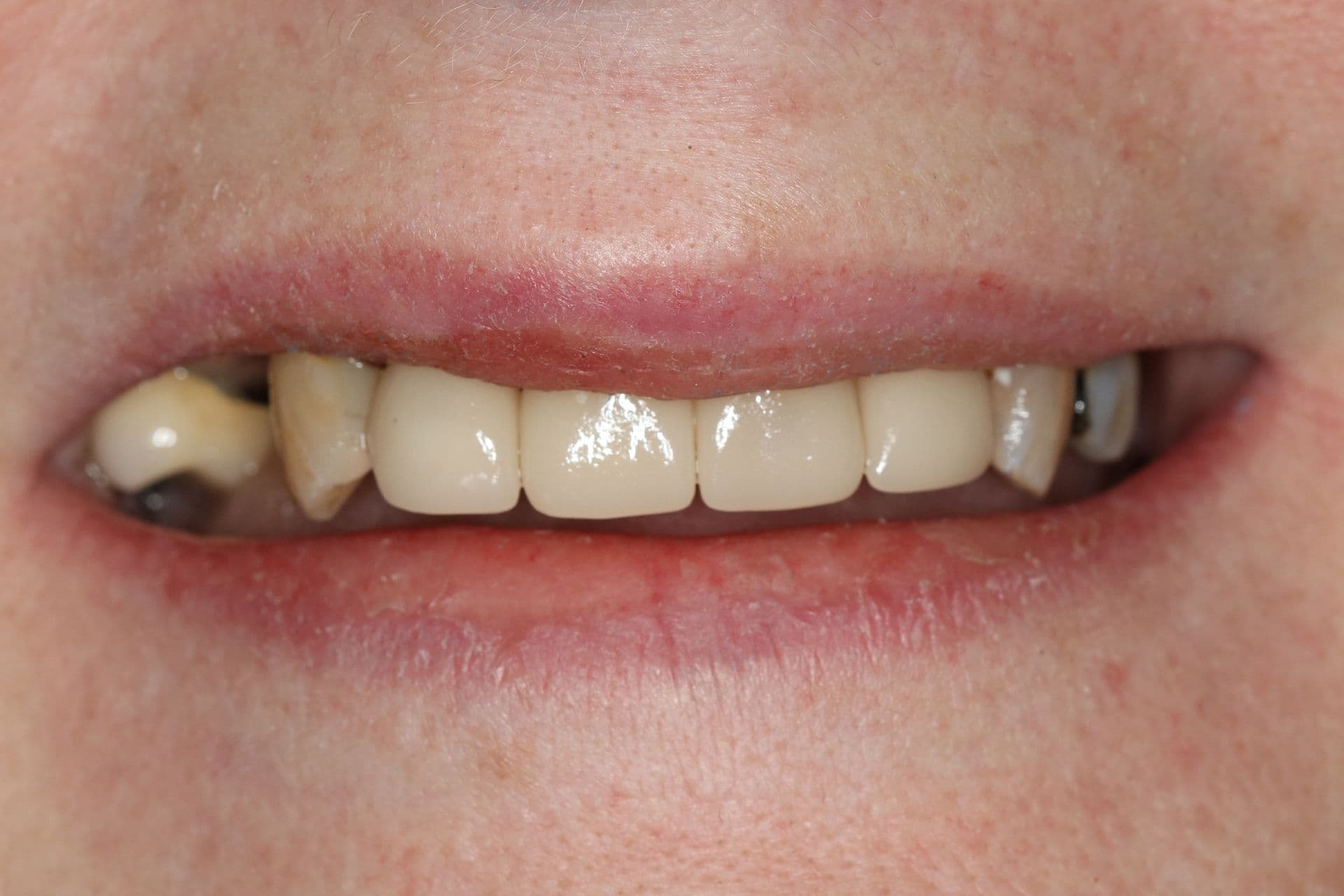 Worn dentition rebuilt and brightened, after treatment