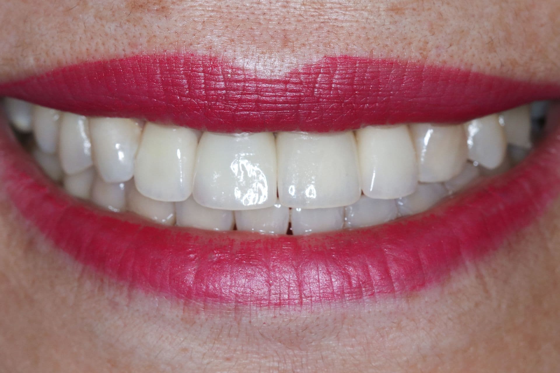 Smile makeover with veneers, after treatment