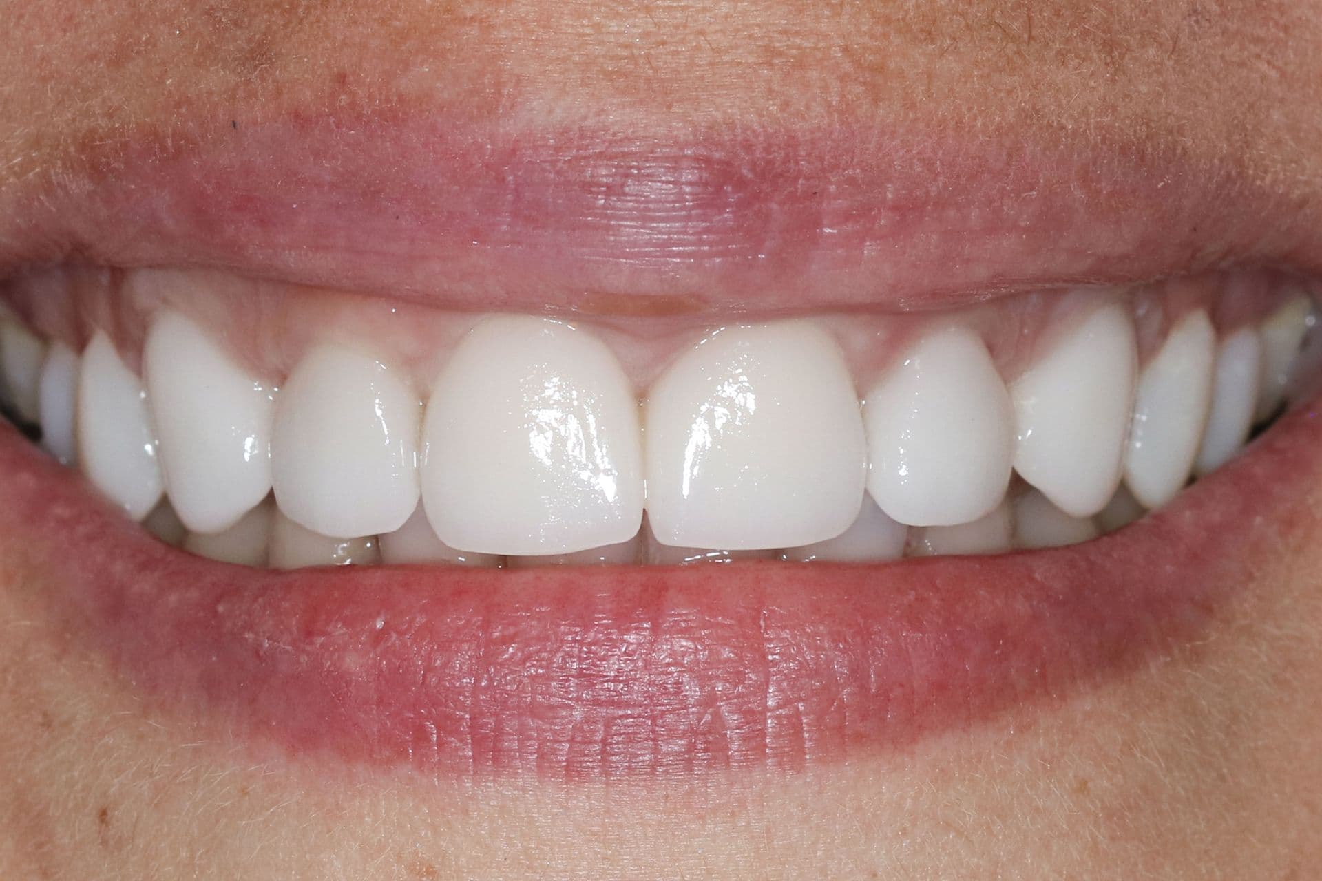 Alignment and shade corrected, after treatment