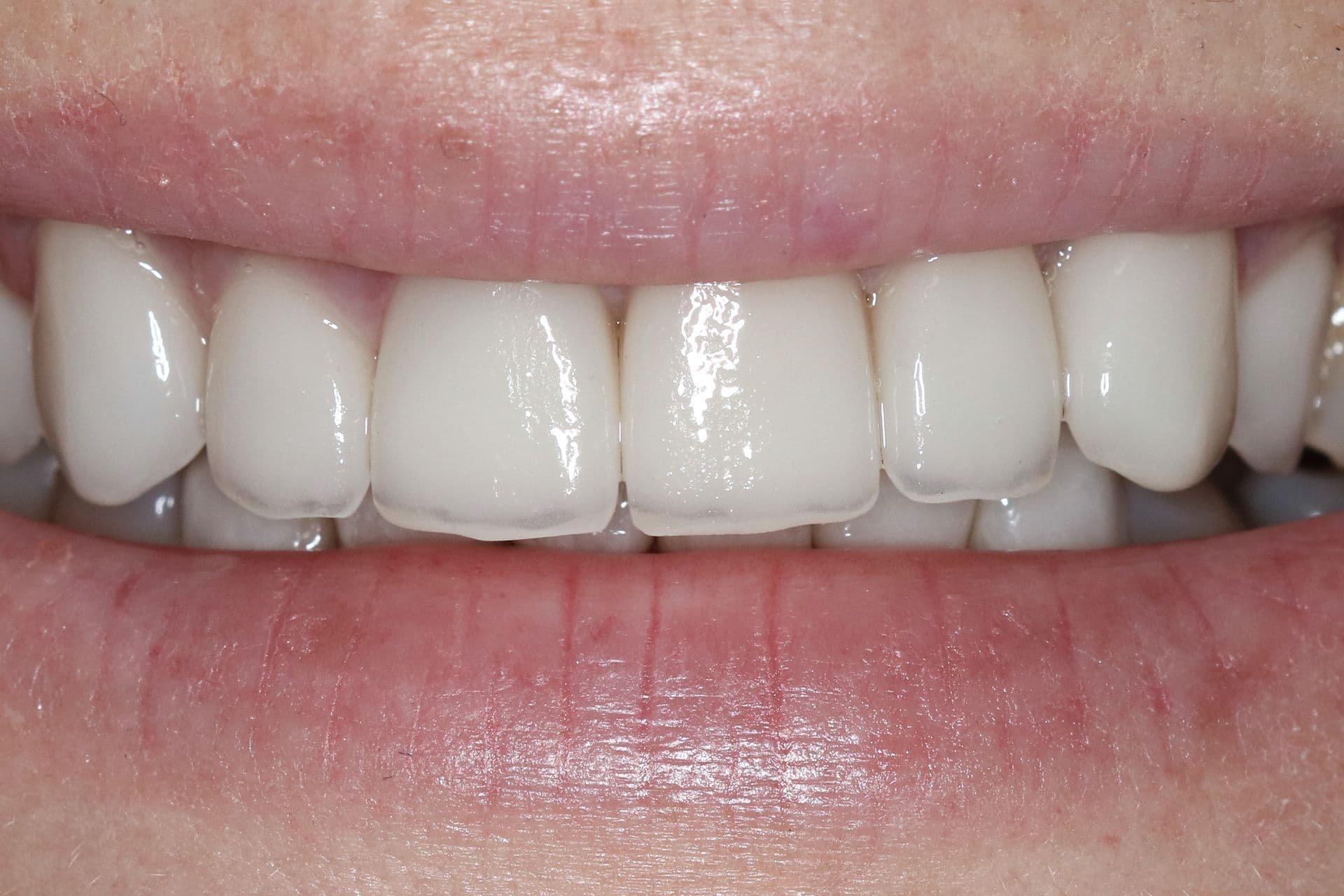 Complete cosmetic smile makeover, after treatment