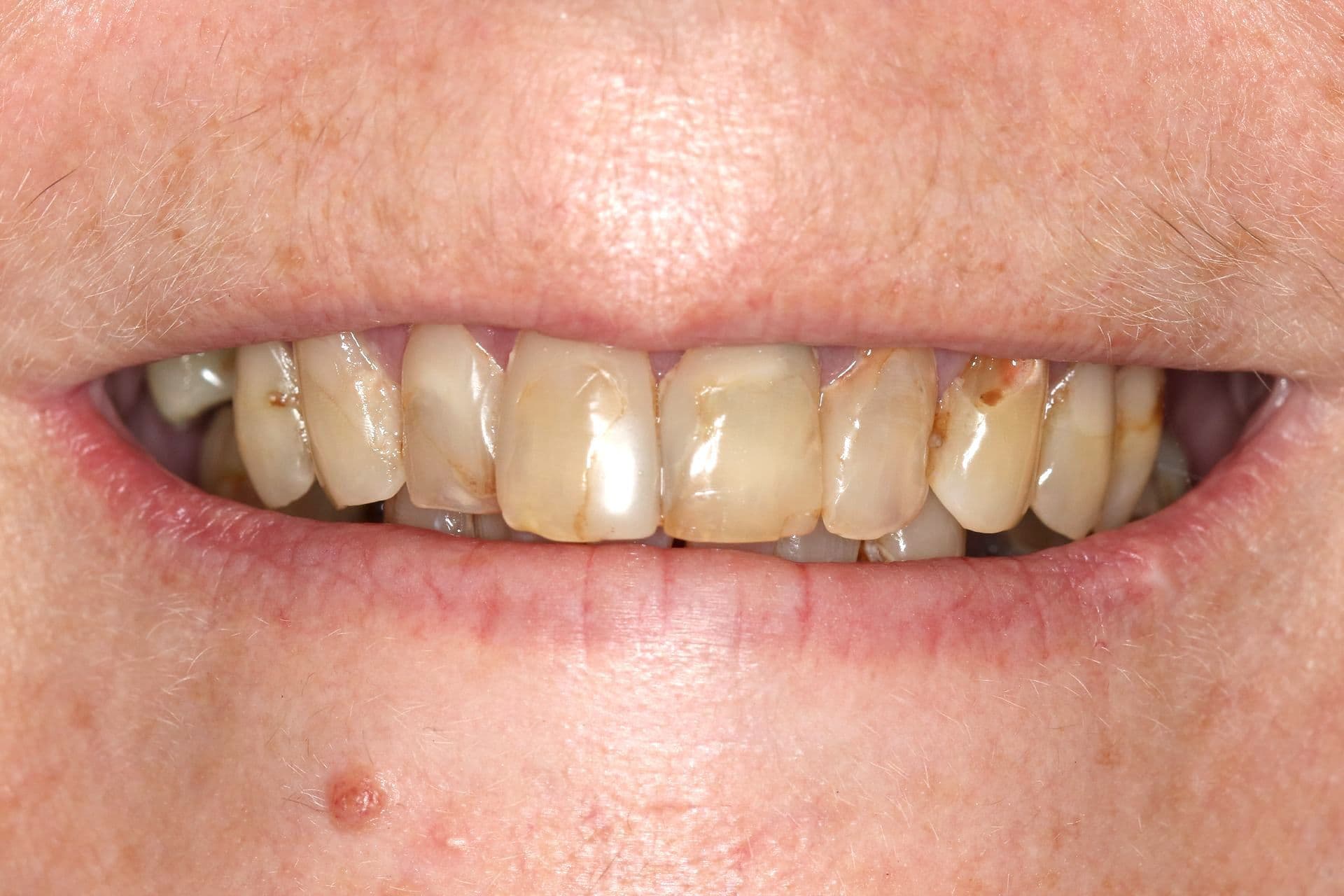 Full smile restoration with porcelain crowns, before treatment