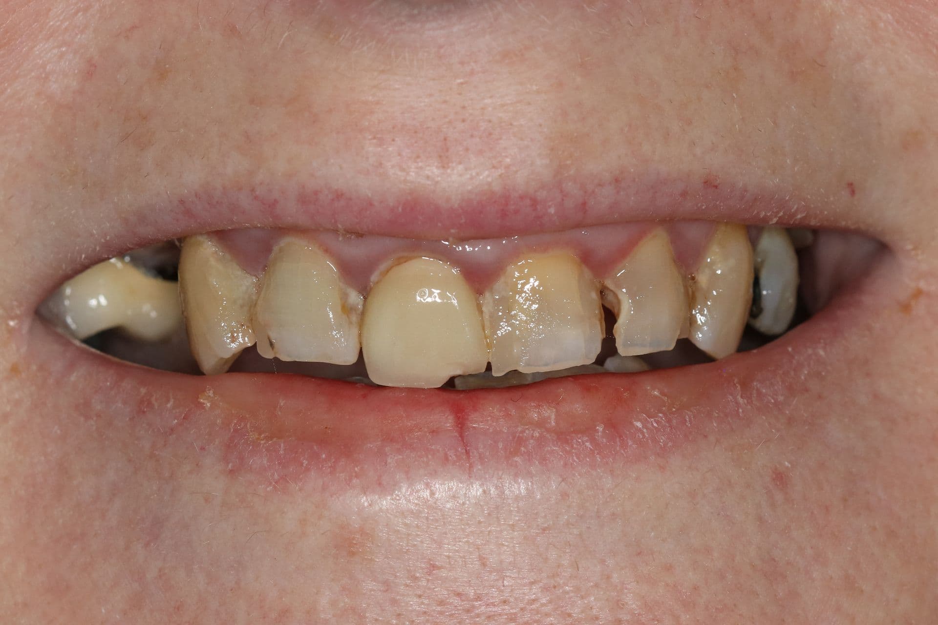 Worn dentition rebuilt and brightened, before treatment