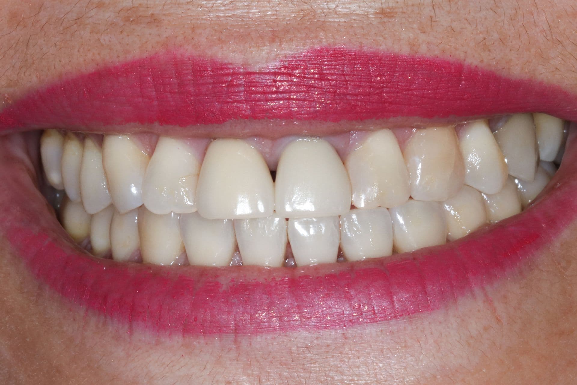 Smile makeover with veneers, before treatment