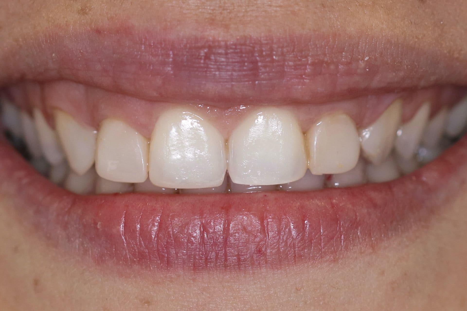 Alignment and shade corrected, before treatment