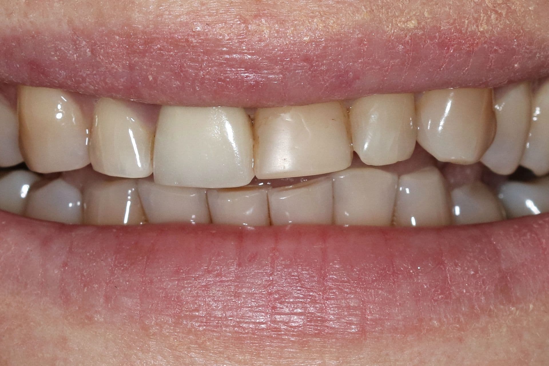 Complete cosmetic smile makeover, before treatment